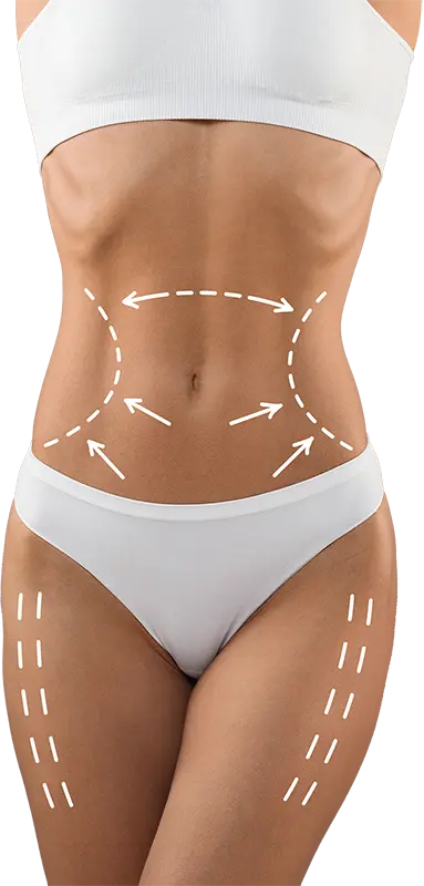 liposuction